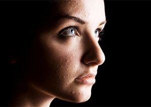 woman with acne