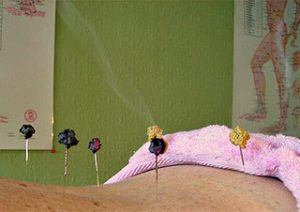 acupuncture